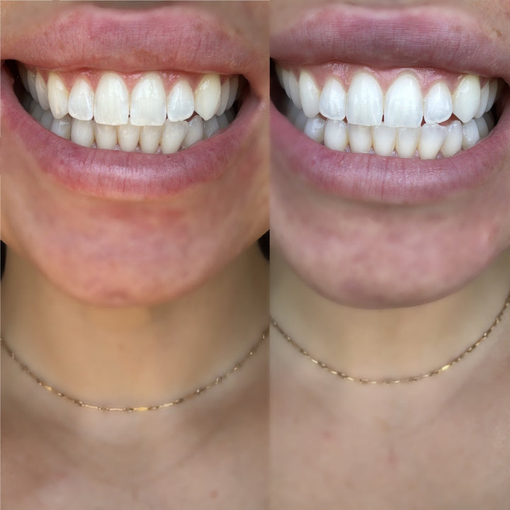 Teeth Whitening Strips